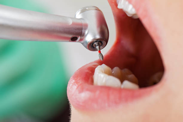 Best Emergency Dentist for Knocked-Out Tooth in Buffalo Center, IA